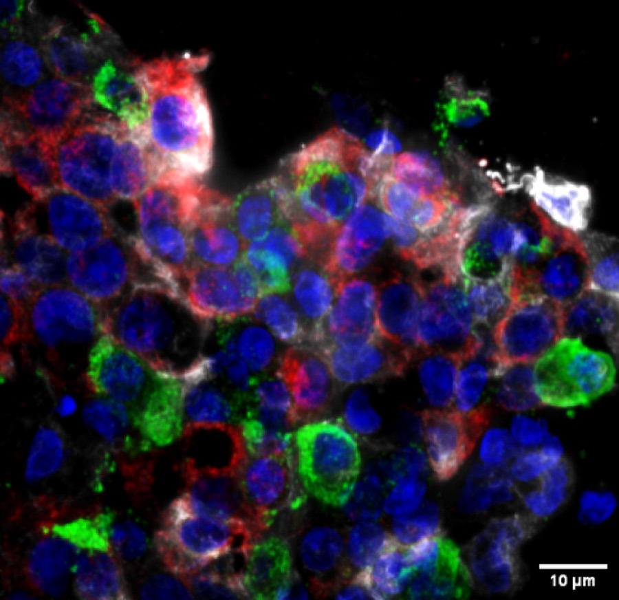 Pancreatic tissue stained for multiple hormone markers